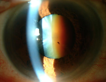 Image montrant une vue détaillée de l'œil humain avec un éclairage réfléchissant sur la cornée et le cristallin, illustrant les effets de la cataracte.