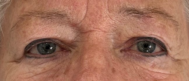 Gros plan sur les yeux d'une personne âgée, montrant des cernes et du maquillage autour des yeux.
