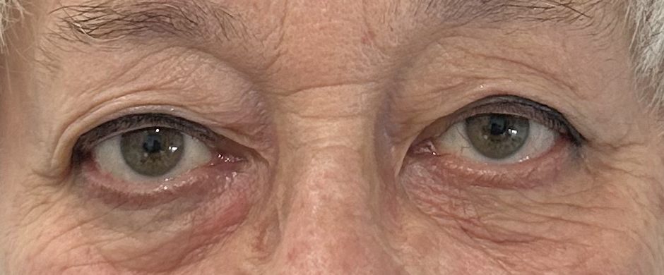 Gros plan sur les yeux d'une personne avec des paupières légèrement tombantes, mettant en évidence des signes de vieillissement et de fatigue.