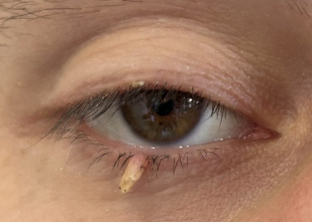 Close-up of a human eye with a small abnormality or discharge in the inner corner.