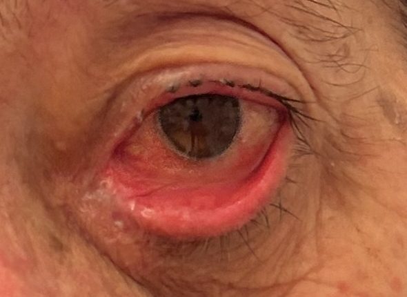 Gros plan d'un œil présentant des signes d'irritation, de rougeur et de gonflement, suggérant une condition comme l'entropion.