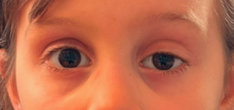 Gros plan des yeux d'un enfant présentant un ptosis, montrant une chute de la paupière supérieure qui peut affecter la symétrie du regard.