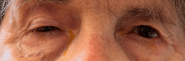 Gros plan sur les yeux d'une personne âgée présentant une paupière tombante et des signes de fatigue.