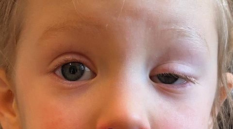Enfant montrant un ptosis de la paupière supérieure, avec un œil plus fermé que l'autre.