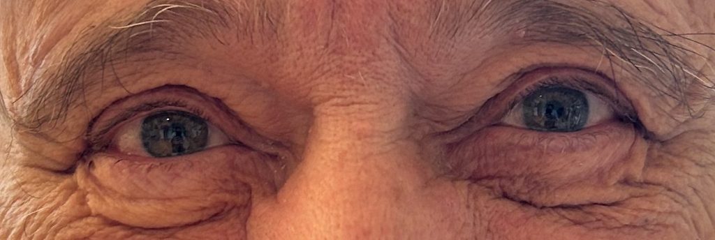 Gros plan sur les yeux d'un adulte, mettant en évidence les rides et l'excès de peau autour des paupières.