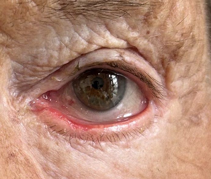 Gros plan sur un œil présentant des signes d'entropion, avec des cils irritant la cornée et une légère rougeur autour de la paupière.