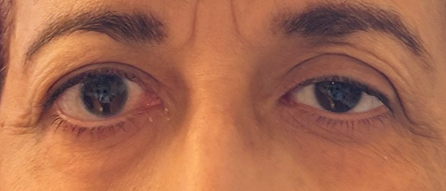 Gros plan des yeux d'une personne montrant des signes de ptosis.