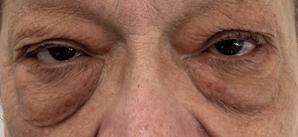 Gros plan sur le visage d'une personne présentant des signes de vieillissement autour des yeux, avec des rides et un relâchement de la peau sur les paupières.