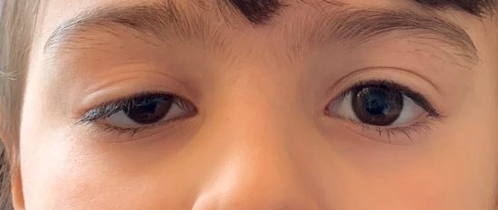 Gros plan sur les yeux d'un enfant présentant une chute de la paupière supérieure, illustrant le ptosis.