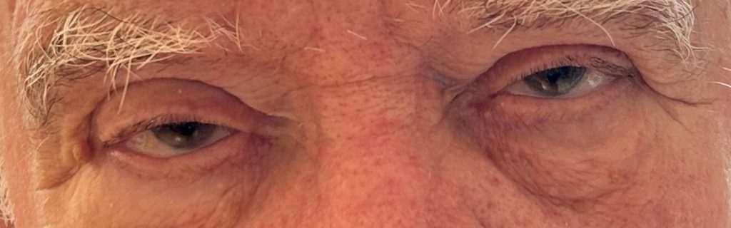 Gros plan sur le visage d'un homme, mettant en évidence ses yeux et les rides autour des paupières, illustrant des signes de ptosis et de vieillissement.