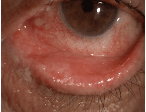 Gros plan sur un œil avec une paupière montrant des signes d'irritation et de rougeur, illustrant un cas d'entropion.