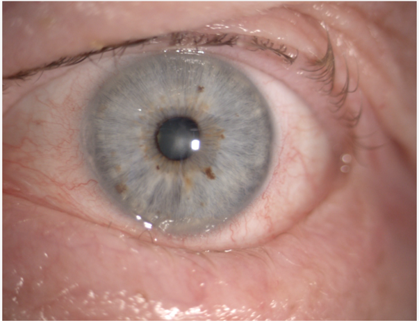 Gros plan sur un œil montrant une iris bleuâtre avec des tâches brunes et des vaisseaux sanguins visibles dans la conjonctive.