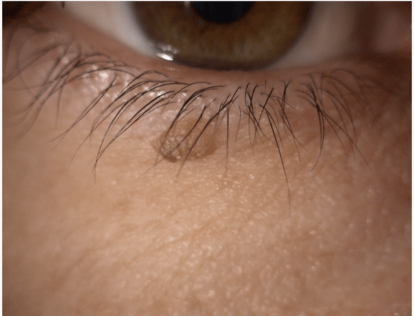 Gros plan sur une paupière supérieure avec un point brun visible sur la peau, montrant les cils et la texture de la peau.