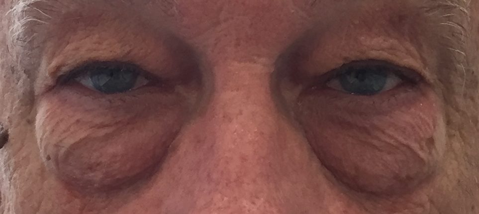 Gros plan sur les yeux d'une personne présentant des poches sous les yeux et des rides autour des paupières, illustrant les effets du vieillissement.